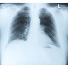 Os sintomas de costelas quebradas ou trincadas