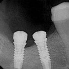 Sinais de infecção em implantes dentários