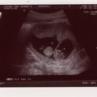 O que esperar na 12ª semana de gravidez de gêmeos
