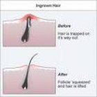 How to Treat Ingrown Hairs on the Scalp | Healthfully