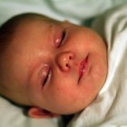 Olhos inchados em bebês
