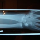 Procedimentos cirúrgicos para instalação de parafusos no braço
