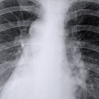 Causas de manchas no pulmão