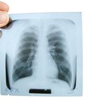 O que é uma grade antidifusora de raios X?