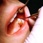Quanto tempo demora para um dente do siso crescer?