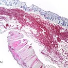 Employment & Crohn's Disease