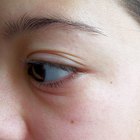 How to Reduce Swelling of Eyelid From a Horsefly Bite