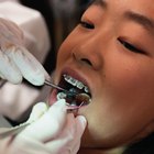 Cómo ponerse elásticos en los frenos de ortodoncia
