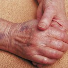 Signs & symptoms of end stage myeloma