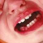 Dolores severos de dentición en bebés