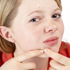Las almendras y las causas del acné