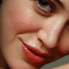 O creme de cloridrato de terbinafina pode ser usado para acne?