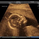 ¿La frecuencia cardíaca puede predecir el sexo de un bebé?