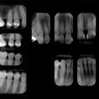 How to Calculate the Decayed, Missing & Filled Teeth Index Ratio