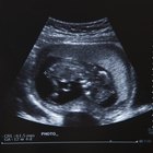 Como comparar o sexo dos bebês em imagens de ultrassom