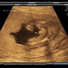 Como descobrir o sexo do bebê em ultrassons