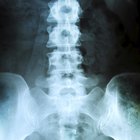 About Thoracic Degenerative Disc Disease | Healthfully