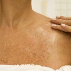 A segurança da monobenzona e o clareamento de pele
