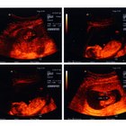 Placenta circunvalada e a restrição ao desenvolvimento fetal