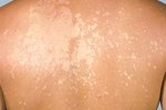 The Best Antifungal Treatments | eHow