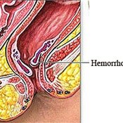 Diagnose Hemorrhoids