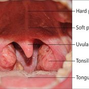 About Adult Tonsillectomy