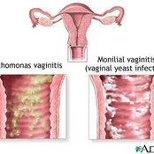 Relief for Vaginal Irritation Itching and Swelling