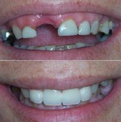 Good partial dentures are impossible to distinguish from your natural teeth.