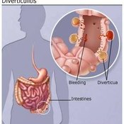 Diverticulitis Diagram
