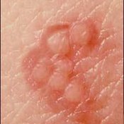 The herpes simplex 1 virus is charactized by small blisters.