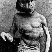 What Are the Symptoms of Elephant Man Disease?