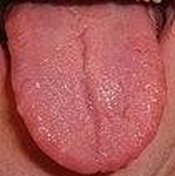 Medical Conditions That Affect the Tongue