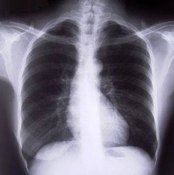 Costochondritis is a painful condition.