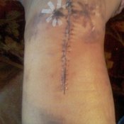 Knee replacement incision