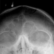 An x-ray showing the sinus cavities