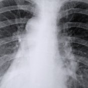 An x-ray view of the lungs.