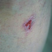 Even a small open wound can result in infection if it is not properly treated.