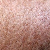 Skin fungus can be uncomfortable and embarrassing