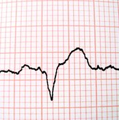 An EKG is a noninvasive test performed on patients suspected to have a heart-related problem.