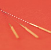 Acupuncture is an alternative form of medicine used to treat many health conditions.