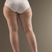 Excess fat in your butt and thighs can lead to a pear-shaped body.