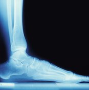 X-ray, flat foot
