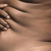 Both overweight and averaged size people can develop stretch marks.