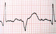 How to Calculate Limit of Detection (LOD)