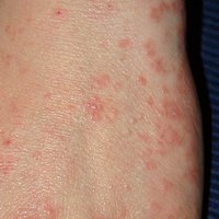 Early Scabies | eHow