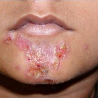 How Does Impetigo Spread? | eHow