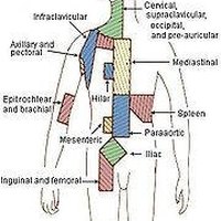 Symptoms of Lymph Node Cancer | eHow