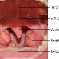 How Long Does Tonsillitis Last? | eHow