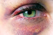 How to Treat a Black Eye (Bruise)