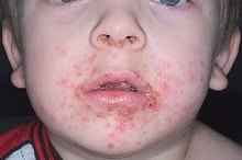 如何识别Impetigo的症状